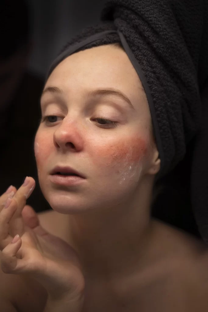 woman-looking-her-rosacea-mirror